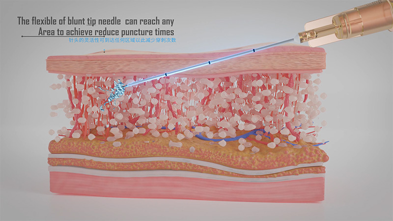 Andromeda™Micro-Cannula_891ee3cd